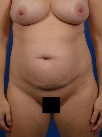 Tummy Tuck Before & After Gallery - Patient 403138 - Image 1