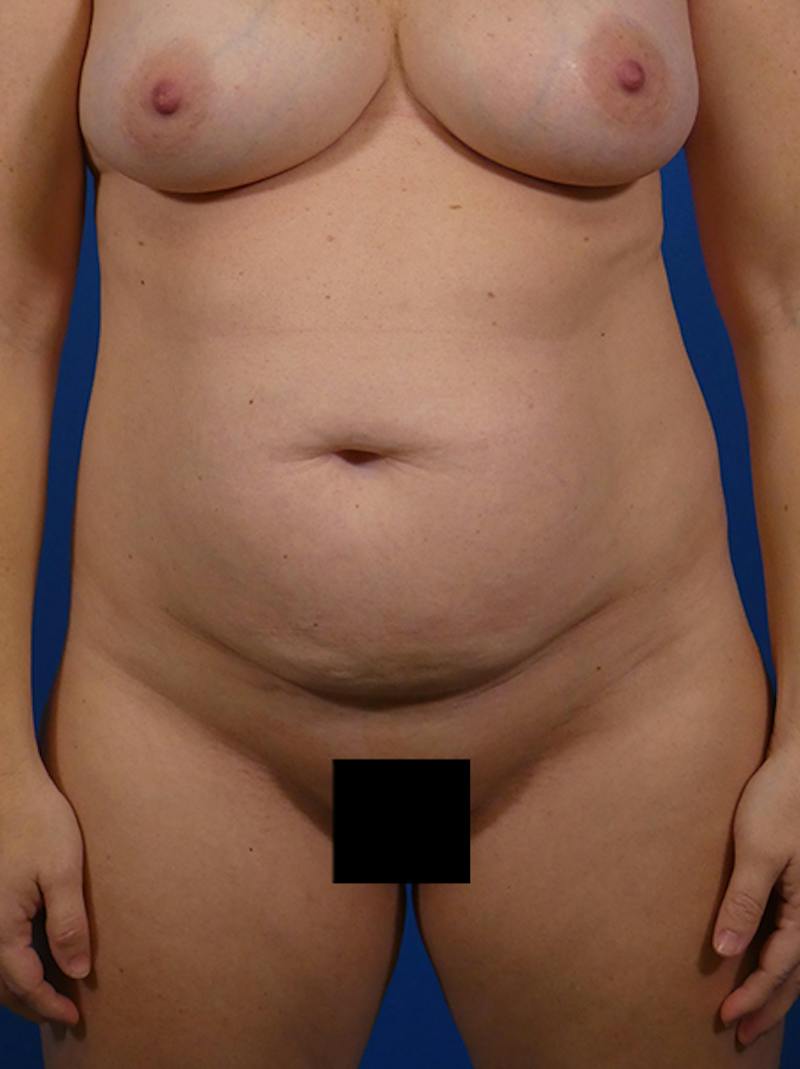 Tummy Tuck Before & After Gallery - Patient 403138 - Image 1
