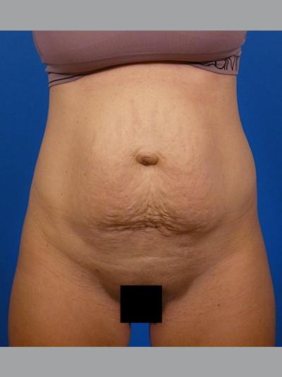 Tummy Tuck Before & After Gallery - Patient 296114 - Image 1