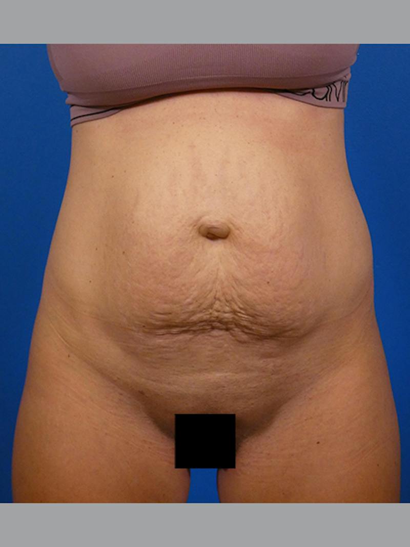 Tummy Tuck Before & After Gallery - Patient 296114 - Image 1