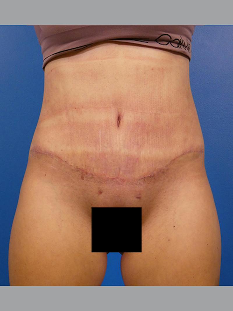 Tummy Tuck Before & After Gallery - Patient 296114 - Image 2