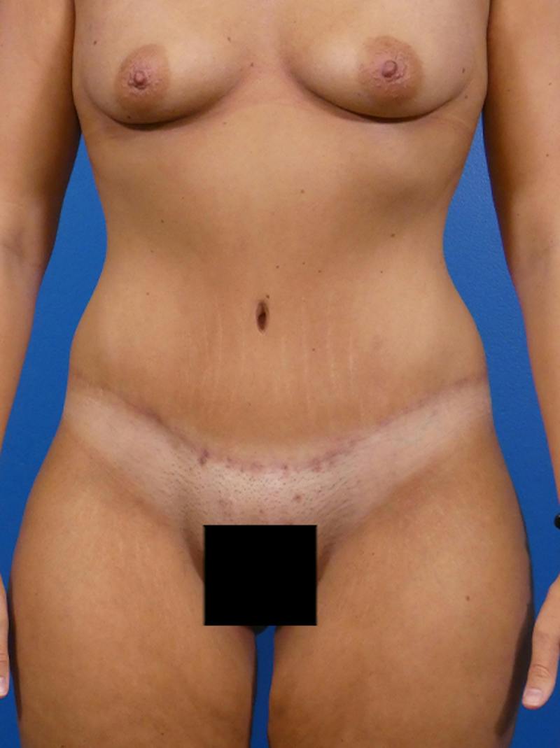 Tummy Tuck Before & After Gallery - Patient 127565 - Image 2