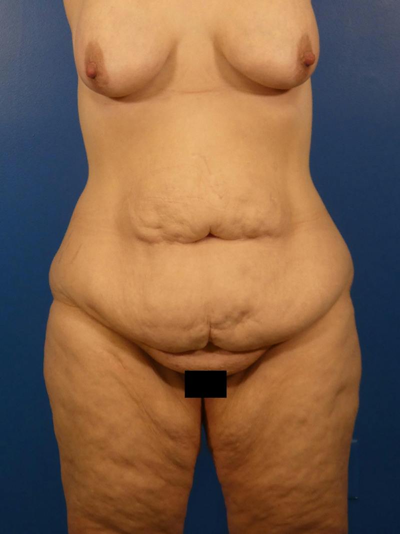 Tummy Tuck Before & After Gallery - Patient 766076 - Image 1