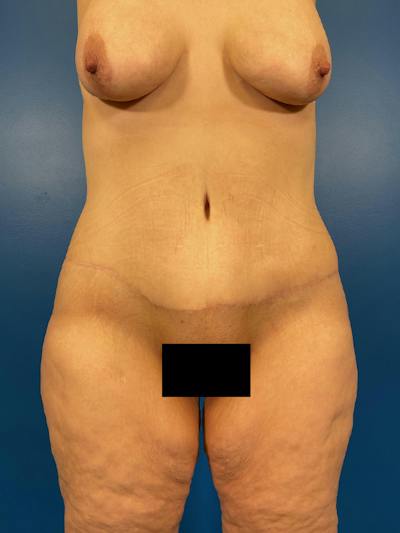 Tummy Tuck Before & After Gallery - Patient 766076 - Image 2