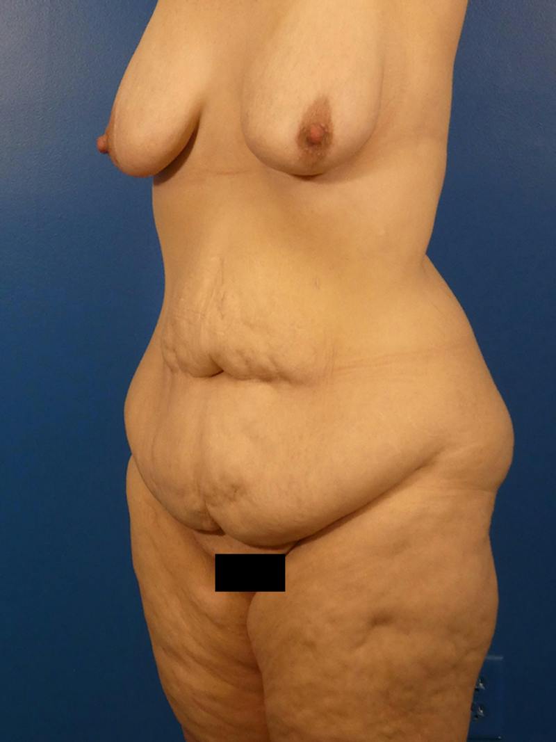 Tummy Tuck Before & After Gallery - Patient 766076 - Image 3