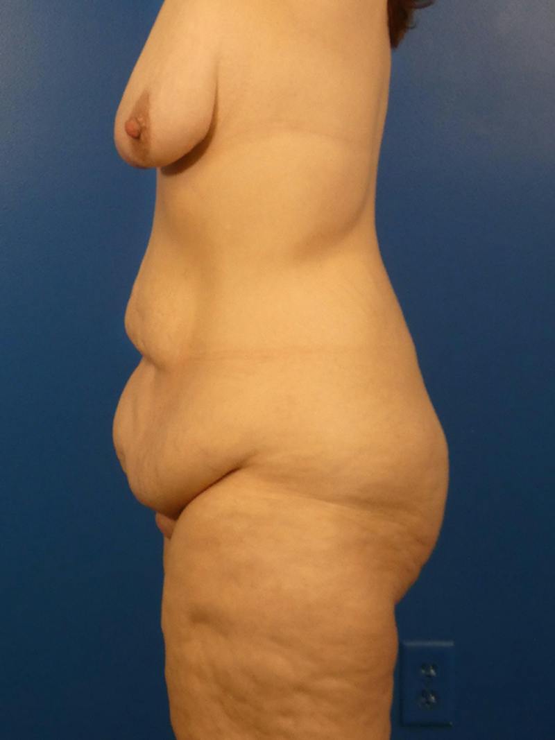 Tummy Tuck Before & After Gallery - Patient 766076 - Image 5