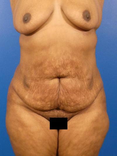Tummy Tuck Before & After Gallery - Patient 341525 - Image 1