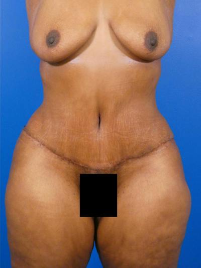 Tummy Tuck Before & After Gallery - Patient 341525 - Image 2