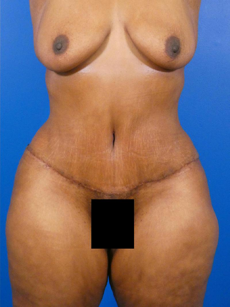 Tummy Tuck Before & After Gallery - Patient 341525 - Image 2