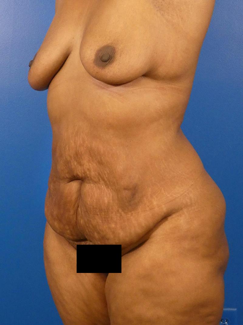 Tummy Tuck Before & After Gallery - Patient 341525 - Image 3