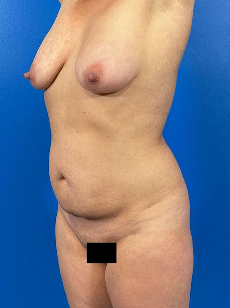 Tummy Tuck Before & After Gallery - Patient 302094 - Image 5