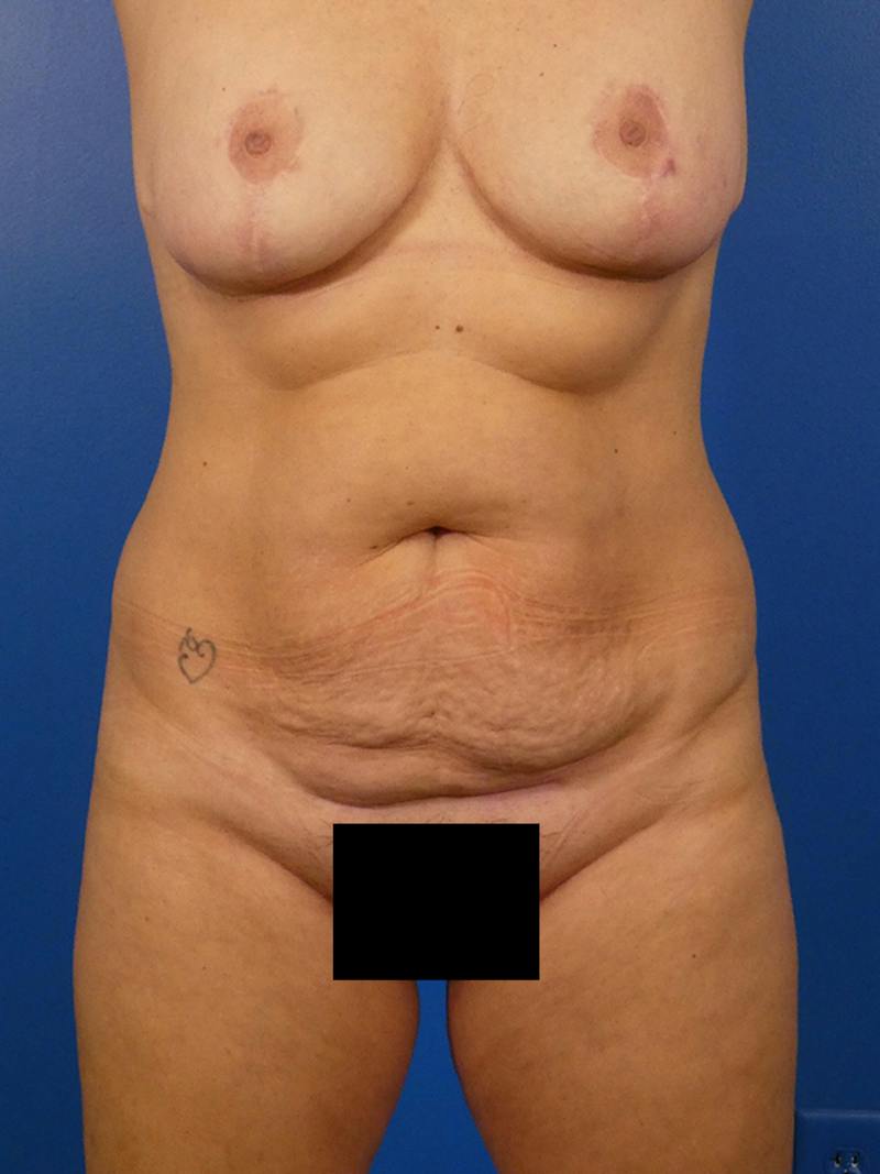 Tummy Tuck Before & After Gallery - Patient 343764 - Image 1