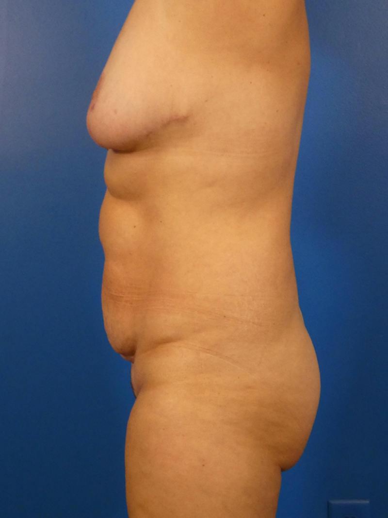 Tummy Tuck Before & After Gallery - Patient 343764 - Image 3