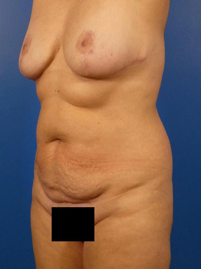 Tummy Tuck Before & After Gallery - Patient 343764 - Image 5