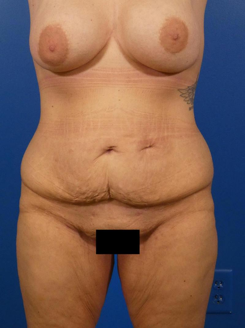 Tummy Tuck Before & After Gallery - Patient 240420 - Image 1
