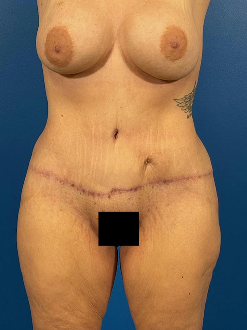 Tummy Tuck Before & After Gallery - Patient 240420 - Image 2