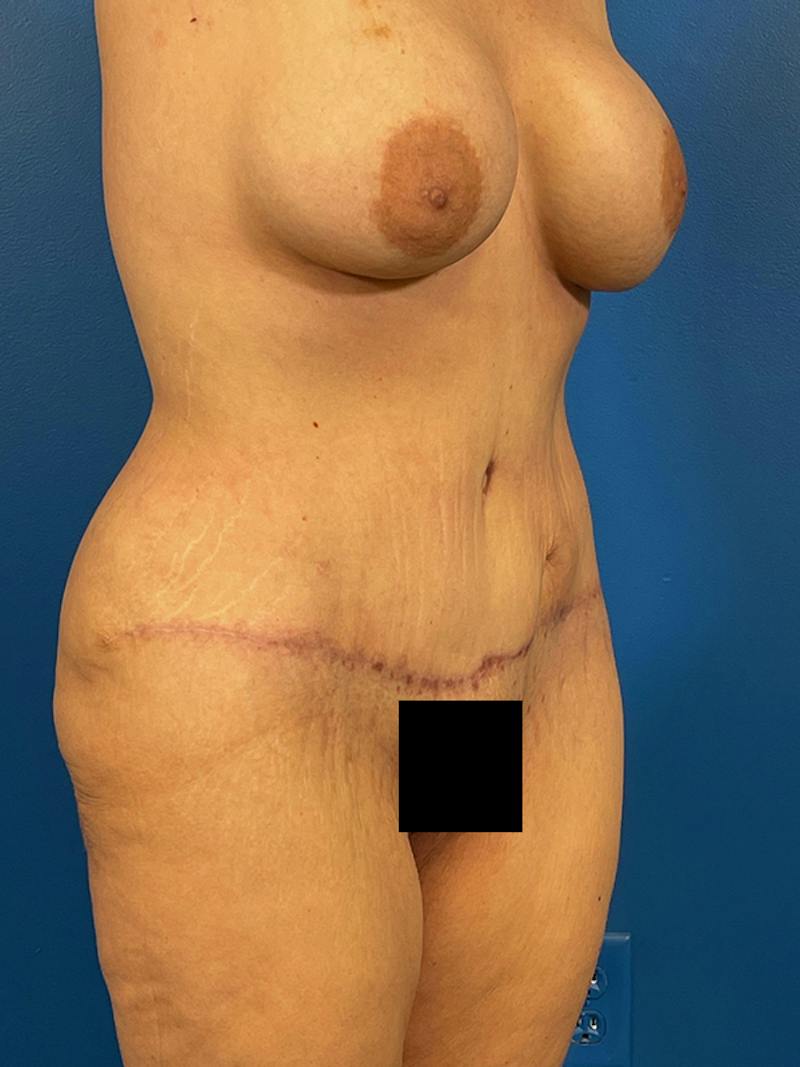Tummy Tuck Before & After Gallery - Patient 240420 - Image 4