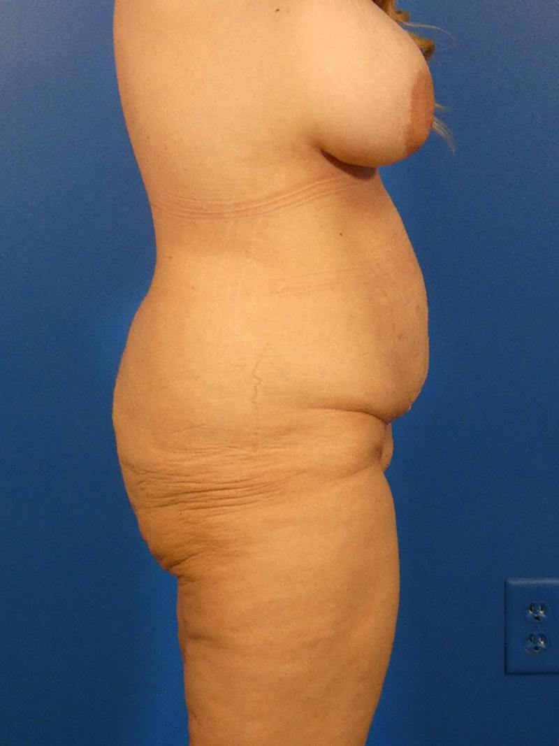 Tummy Tuck Before & After Gallery - Patient 240420 - Image 5