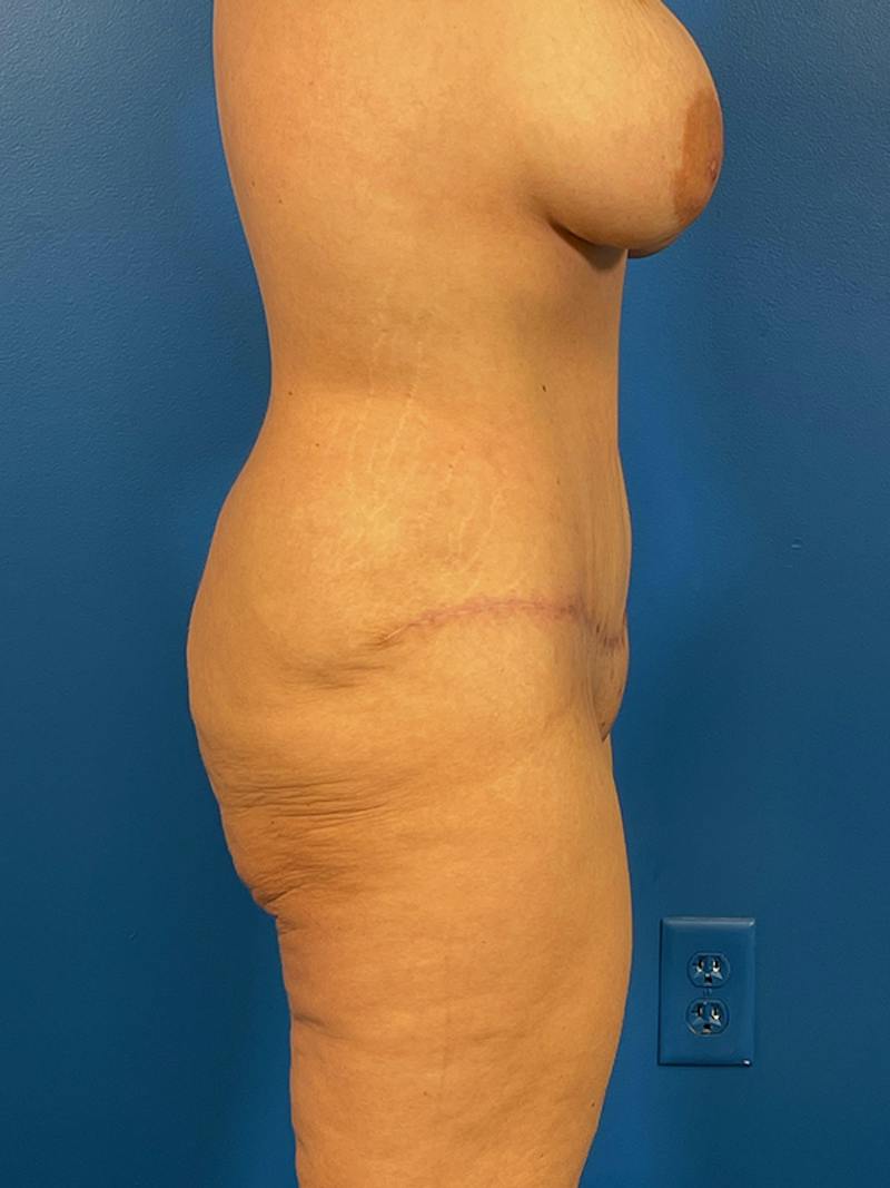 Tummy Tuck Before & After Gallery - Patient 240420 - Image 6