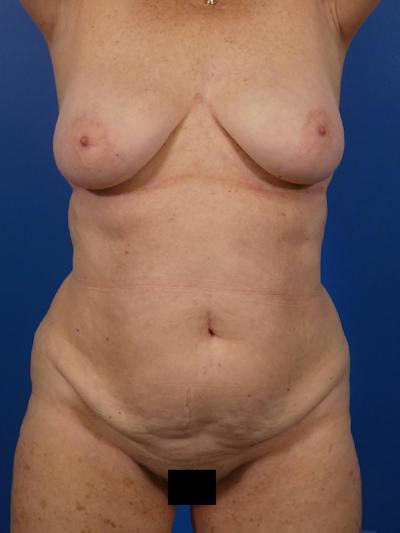 Tummy Tuck Before & After Gallery - Patient 139644 - Image 1