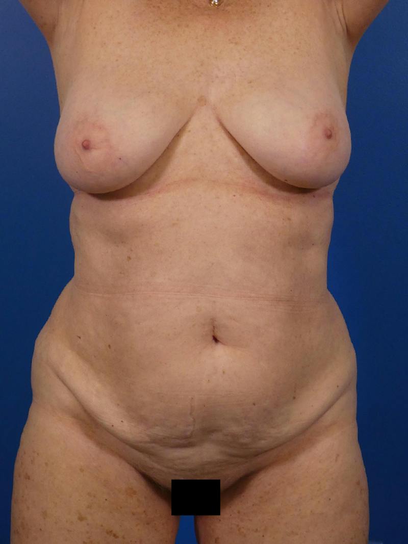 Tummy Tuck Before & After Gallery - Patient 139644 - Image 1