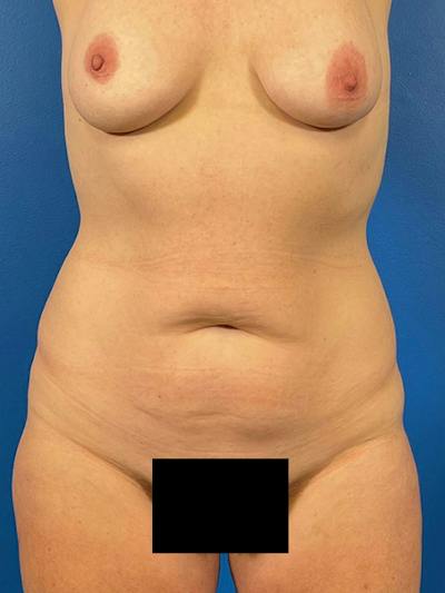 Tummy Tuck Before & After Gallery - Patient 227427 - Image 1