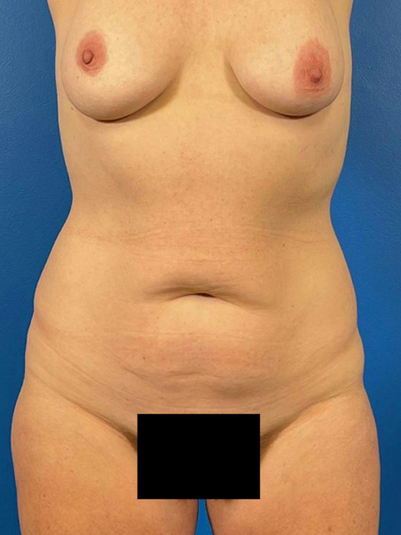 Tummy Tuck Before & After Gallery - Patient 227427 - Image 1