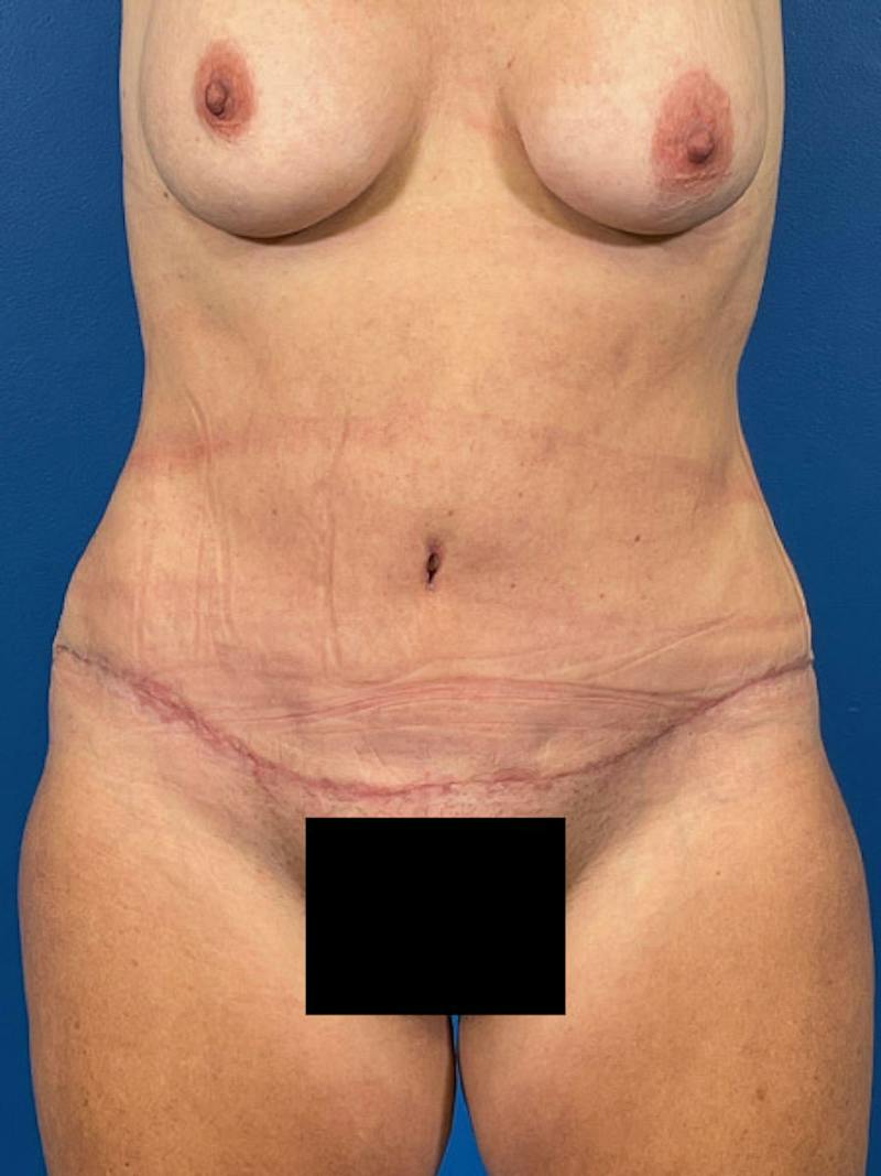 Tummy Tuck Before & After Gallery - Patient 227427 - Image 2