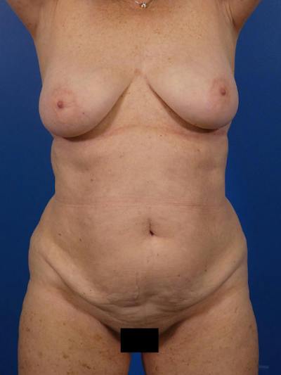 Tummy Tuck Before & After Gallery - Patient 284282 - Image 1