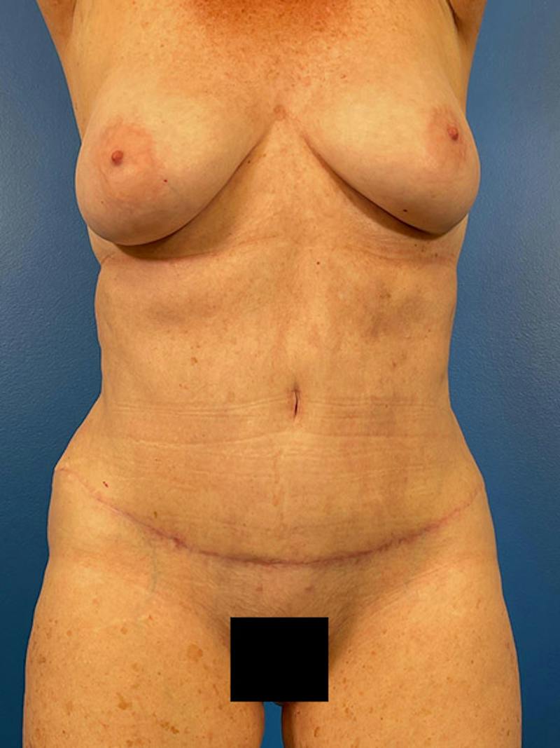 Tummy Tuck Before & After Gallery - Patient 284282 - Image 2