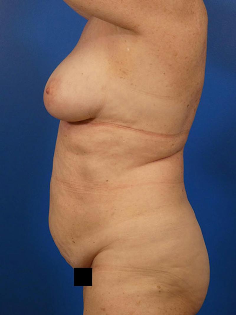 Tummy Tuck Before & After Gallery - Patient 284282 - Image 5