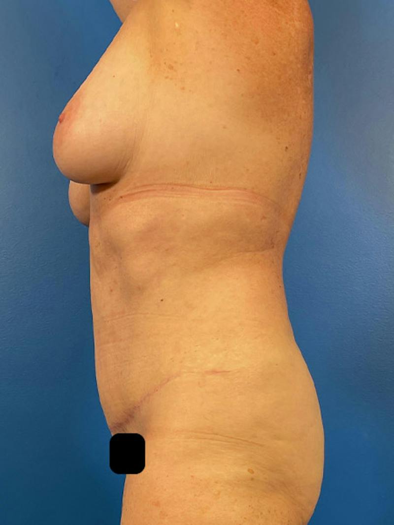 Tummy Tuck Before & After Gallery - Patient 284282 - Image 6
