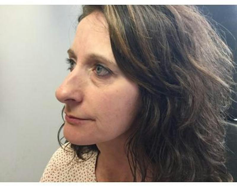 Injectables Face Before & After Gallery - Patient 429225 - Image 5