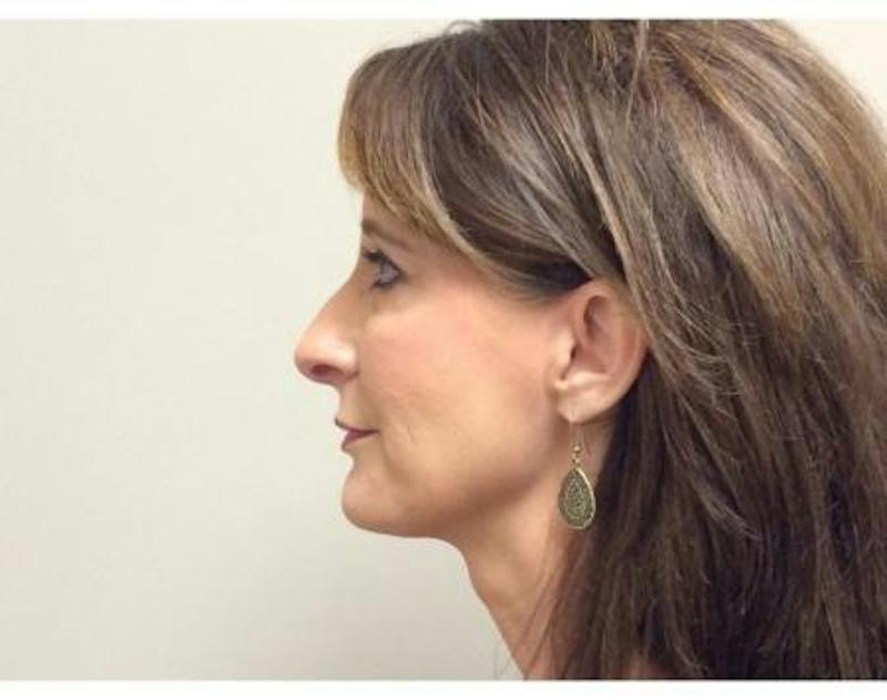 Injectables Face Before & After Gallery - Patient 429225 - Image 6