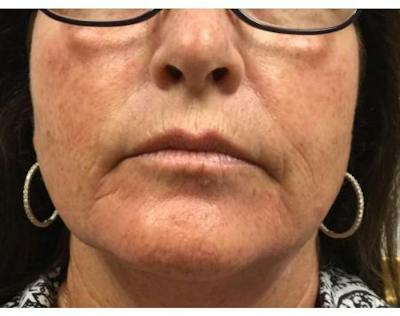 Injectables Face Before & After Gallery - Patient 179877 - Image 1