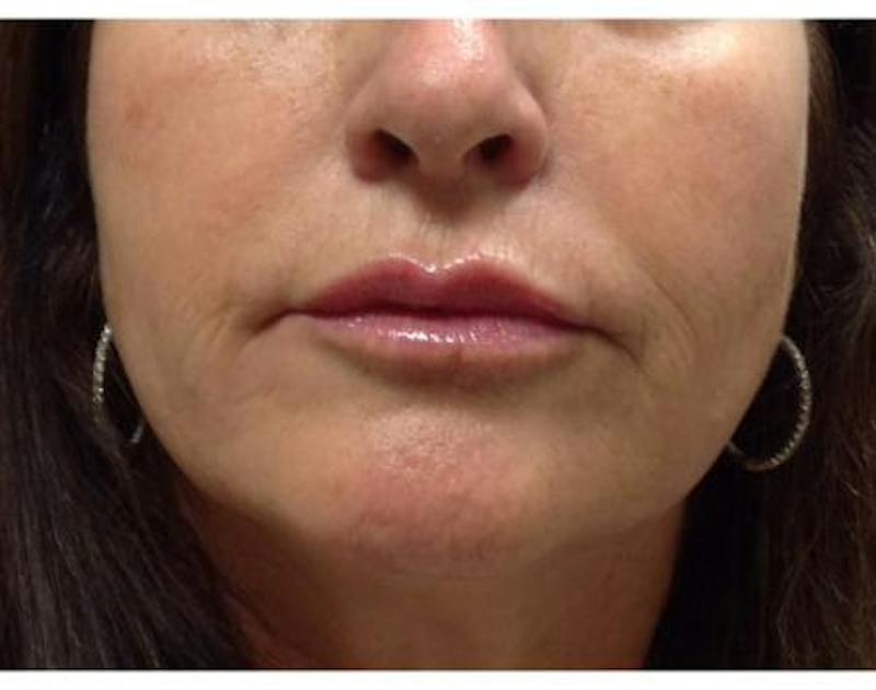 Injectables Face Before & After Gallery - Patient 179877 - Image 2