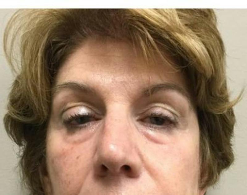 Injectables Face Before & After Gallery - Patient 140711 - Image 1
