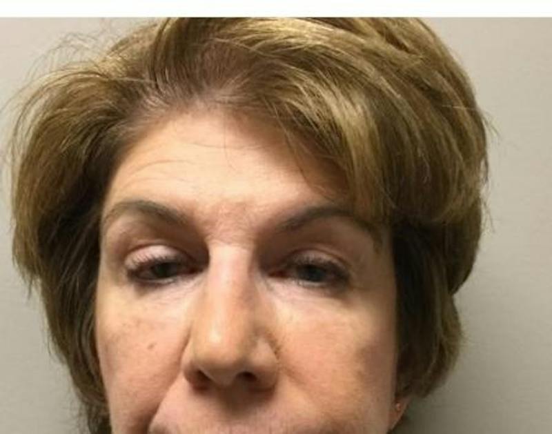 Injectables Face Before & After Gallery - Patient 140711 - Image 2