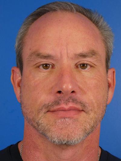 Injectables Face Before & After Gallery - Patient 435524 - Image 2