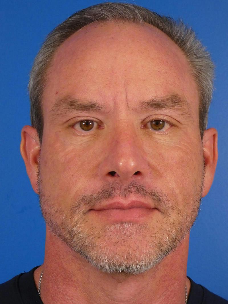 Injectables Face Before & After Gallery - Patient 435524 - Image 2