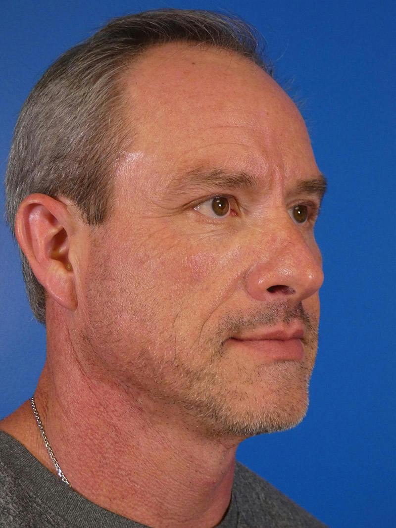 Injectables Face Before & After Gallery - Patient 435524 - Image 3