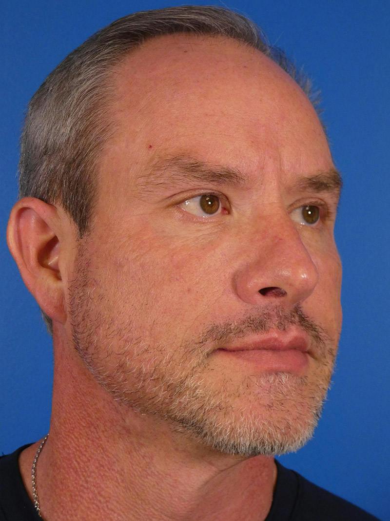 Injectables Face Before & After Gallery - Patient 435524 - Image 4
