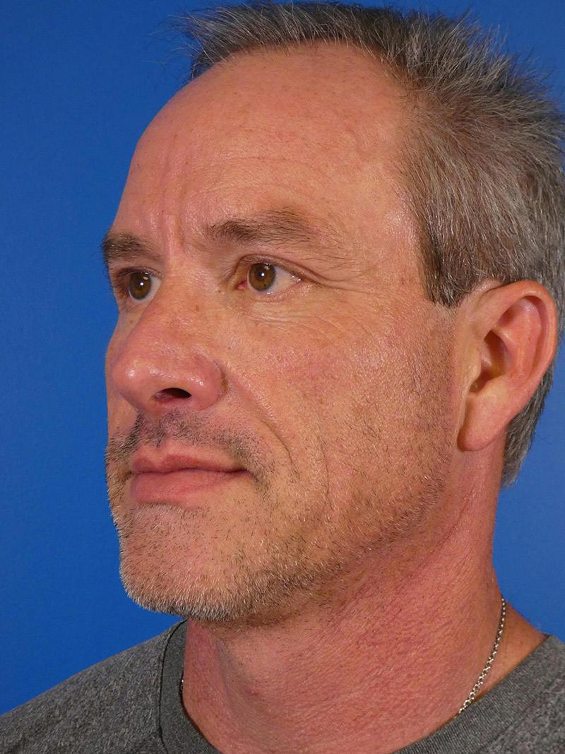 Injectables Face Before & After Gallery - Patient 435524 - Image 5