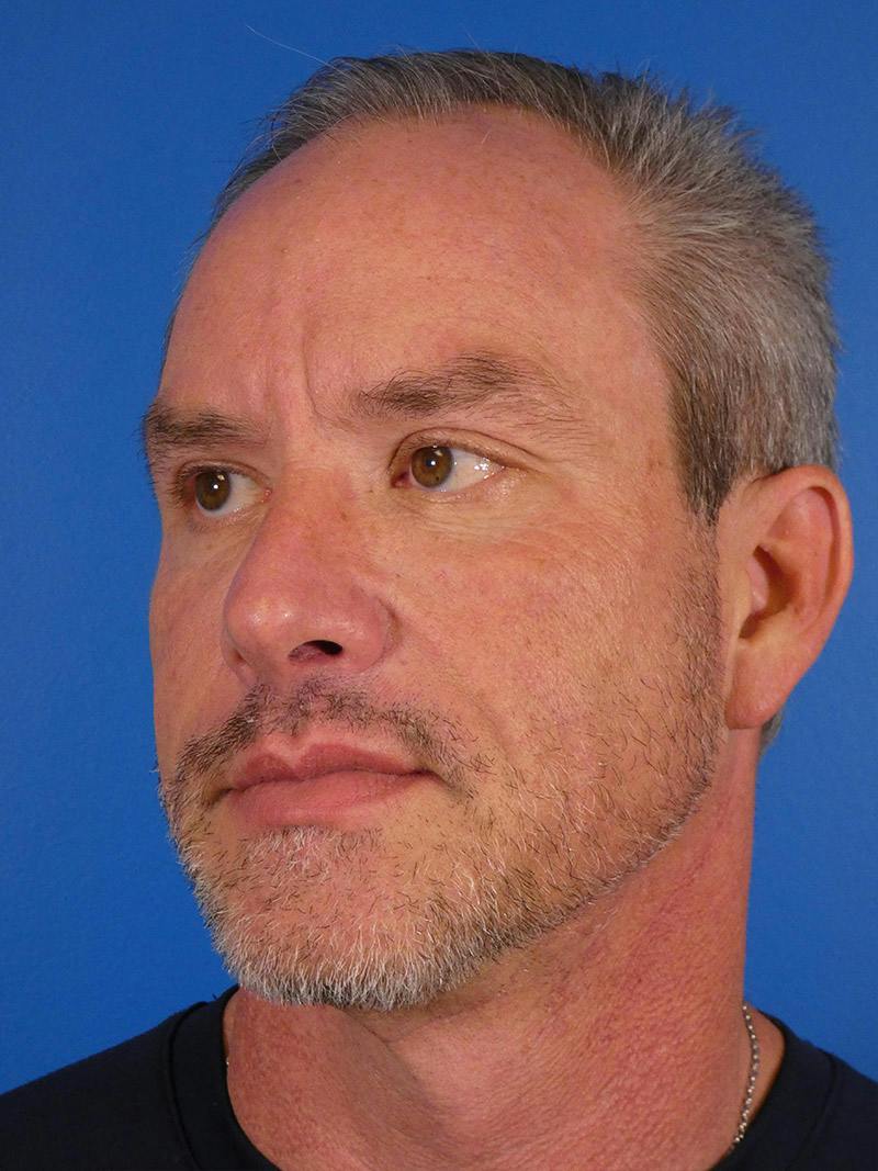 Injectables Face Before & After Gallery - Patient 435524 - Image 6