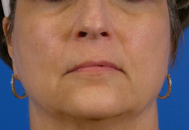 Injectables Face Before & After Gallery - Patient 308411 - Image 1