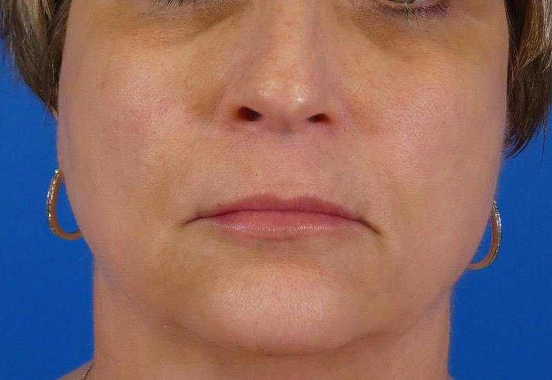 Injectables Face Before & After Gallery - Patient 308411 - Image 2