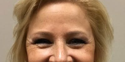 Injectables Face Before & After Gallery - Patient 144690 - Image 1