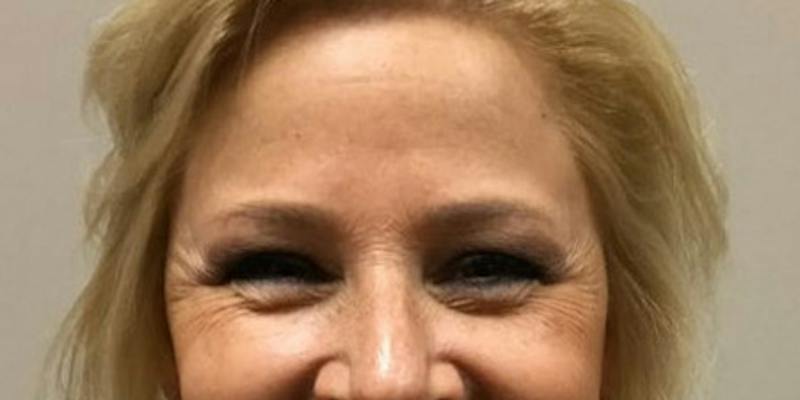 Injectables Face Before & After Gallery - Patient 144690 - Image 1