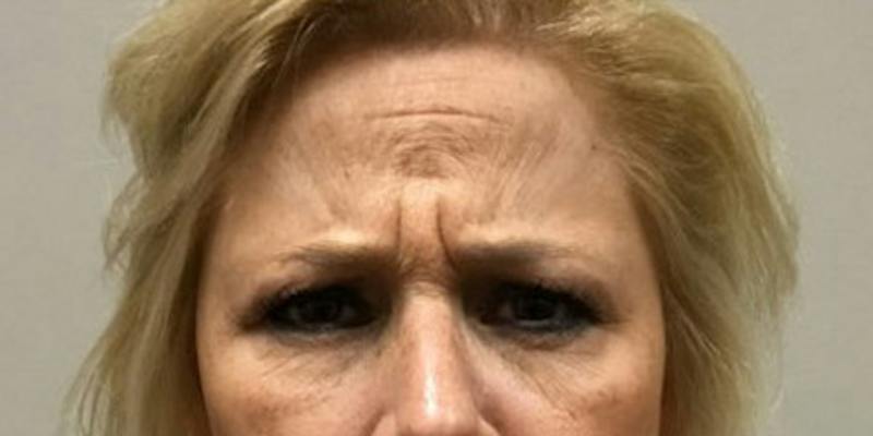 Injectables Face Before & After Gallery - Patient 144690 - Image 3