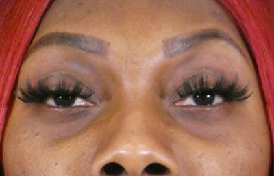 Under Eye Filler Before & After Gallery - Patient 372285 - Image 1